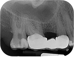 Die endodontische Behandlung